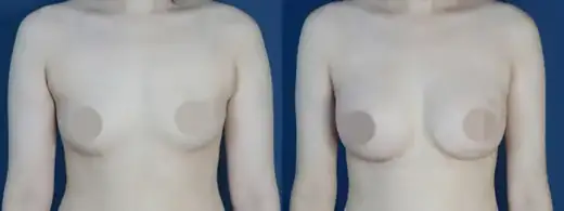 Arm liposuction at Re nu Plastic Surgery. Front view