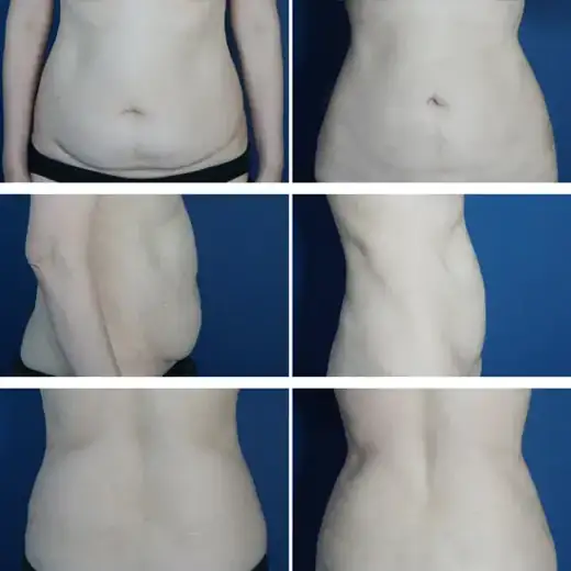 Abdominal liposuction at Re nu Plastic Surgery. Before and after