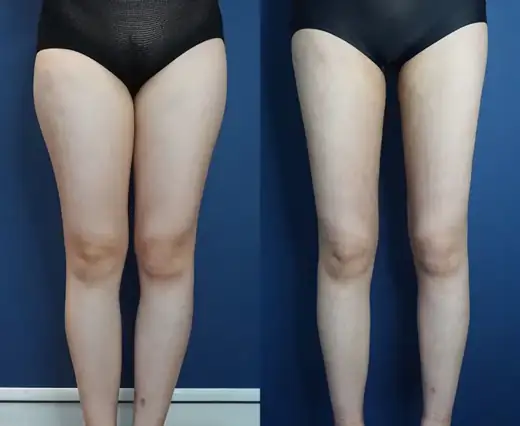 Thigh liposuction at Re nu Plastic Surgery. Front view