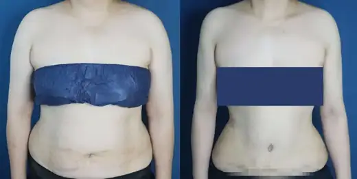 Abdominal and upper-body liposuction at Re nu Plastic Surgery. Front view