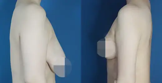 Arm liposuction at Re nu Plastic Surgery. Before and after