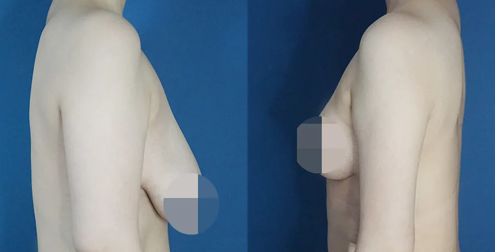 Arm liposuction at Re nu Plastic Surgery. Before and after