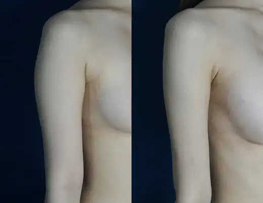 Arm liposuction at Re nu Plastic Surgery. Before and after