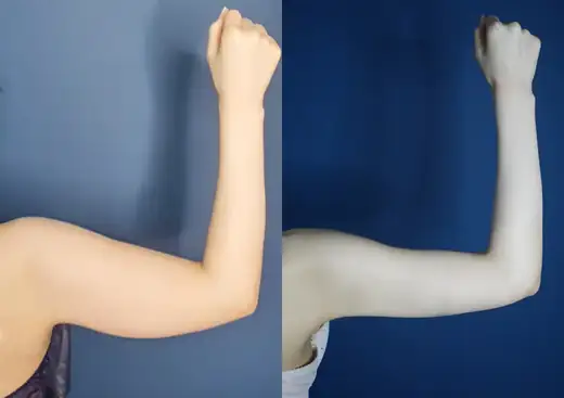 Arm liposuction at Re nu Plastic Surgery. Before and after