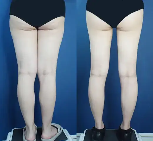 Thigh and calf liposuction at Re nu Plastic Surgery. Before and after