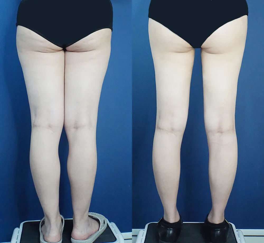 Thigh and calf liposuction at Re nu Plastic Surgery. Before and after