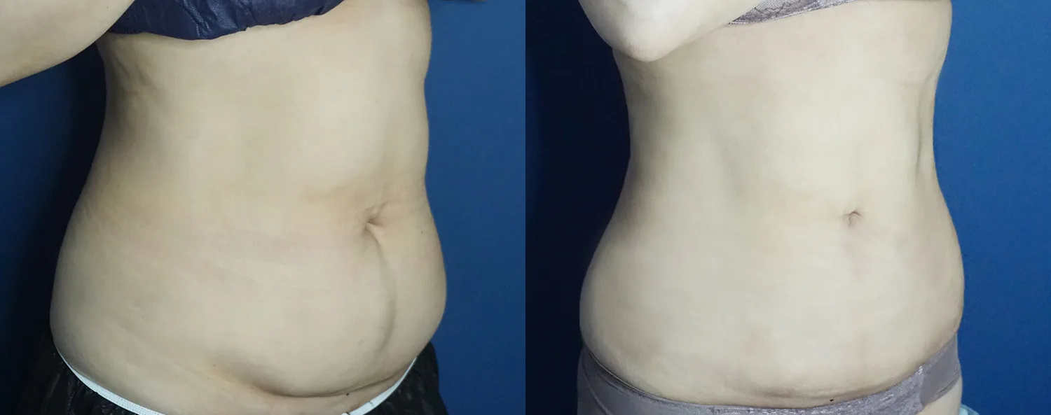 Abdominal liposuction at Re nu Plastic Surgery. Oblique view