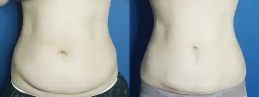 Abdominal liposuction at Re nu Plastic Surgery. Before and after