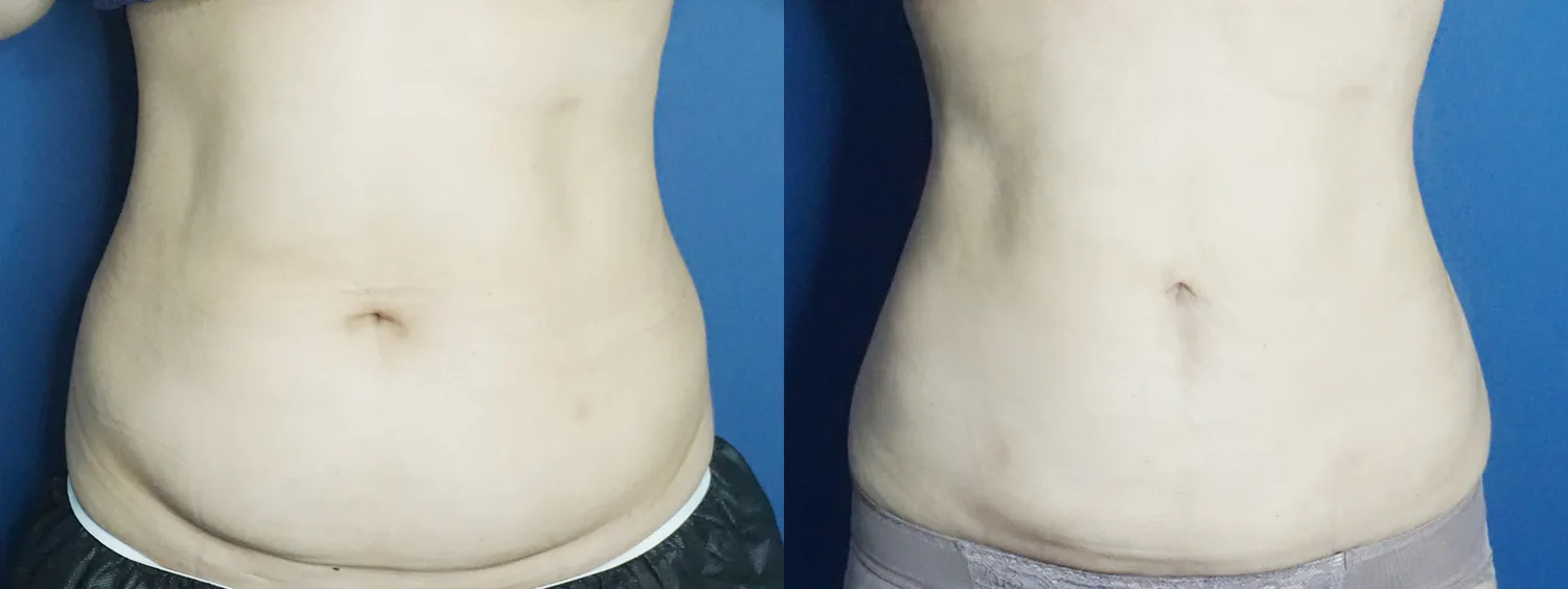Abdominal liposuction at Re nu Plastic Surgery. Before and after