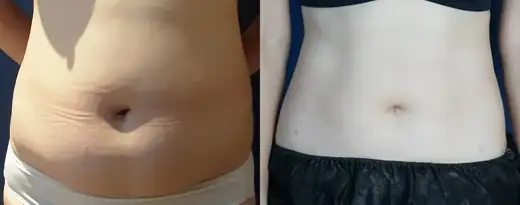 Abdominal liposuction at Re nu Plastic Surgery. Before and after