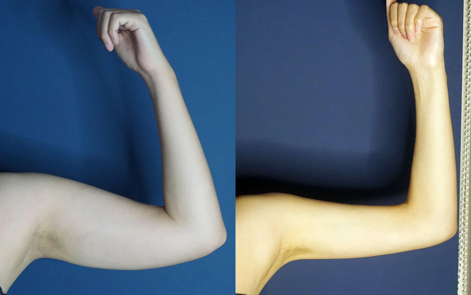 Arm liposuction at Re nu Plastic Surgery. Before and after