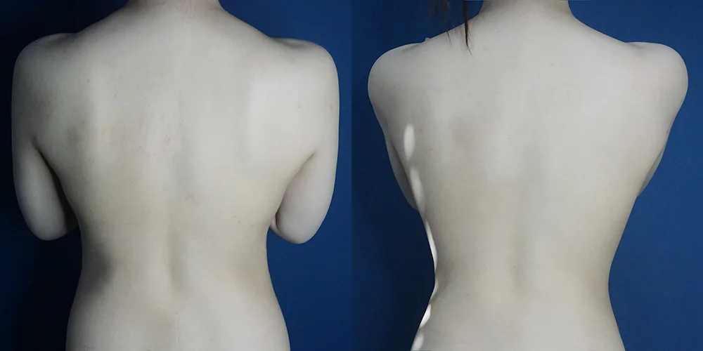 Abdominal and bra-line and back liposuction at Re nu Plastic Surgery. Before and after