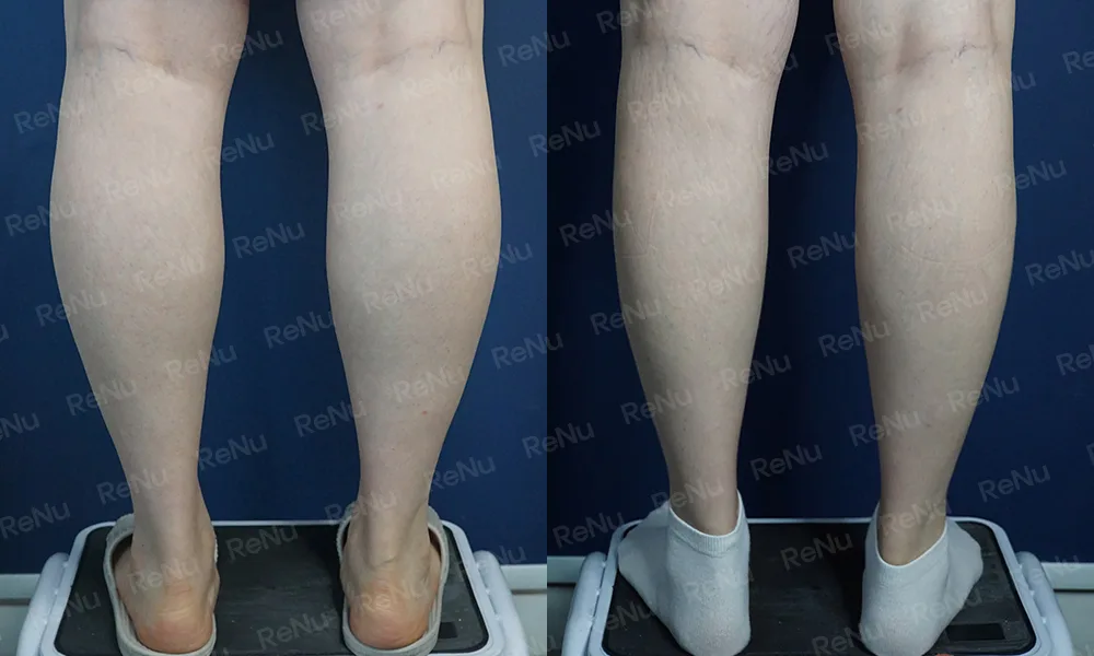 Calf liposuction at Re nu Plastic Surgery. Before and after