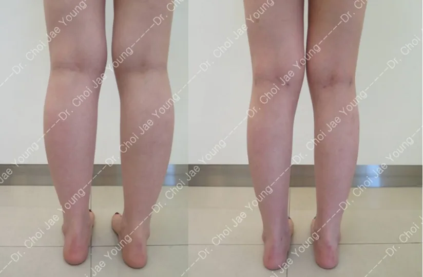Calf liposuction at Re nu Plastic Surgery. Before and after