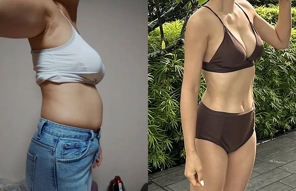 Arm and abdominal liposuction at Re nu Plastic Surgery. Before and after