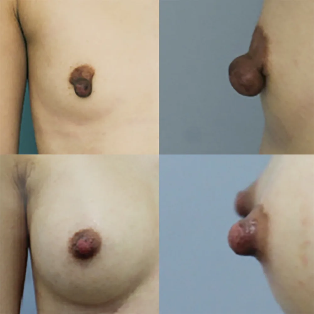 Nipple reduction at Re nu Plastic Surgery. Before and after
