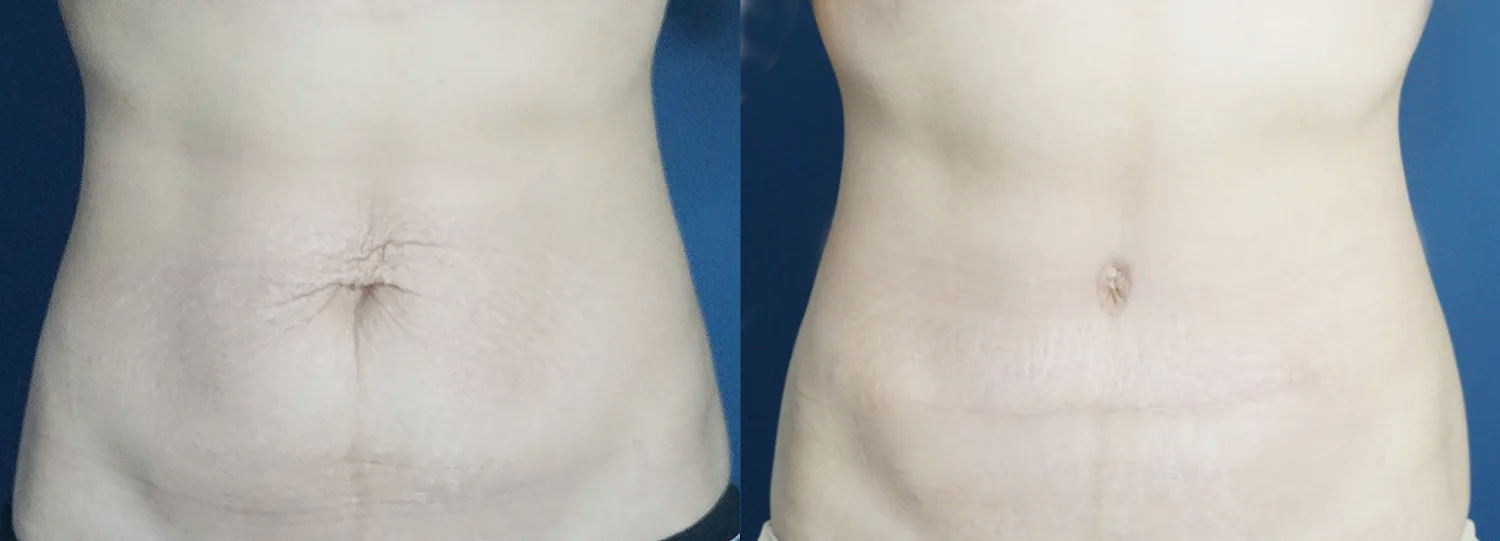 Lower tummy tuck at Re nu Plastic Surgery. Before and after