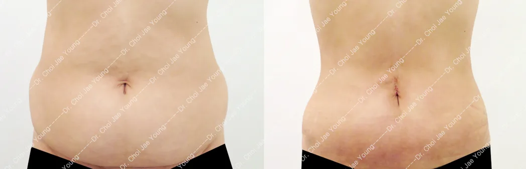 Lower tummy tuck at Re nu Plastic Surgery. Before and after