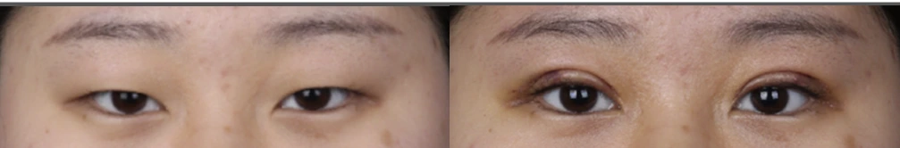 Incisional eyelid-opening correction — before on the left and after on the right at Afternoon Plastic Surgery