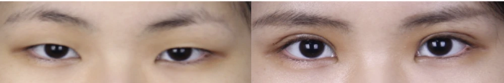 Incisional eyelid-opening correction — before on the left and after on the right at Afternoon Plastic Surgery