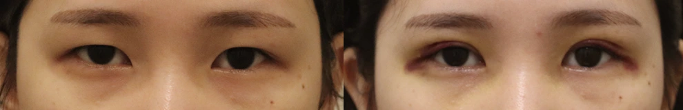 Incisional eyelid-opening correction — before on the left and after on the right at Afternoon Plastic Surgery
