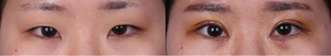 Incisional double-eyelid surgery with inner eye-corner surgery — before on the left and after on the right at Afternoon Plastic Surgery