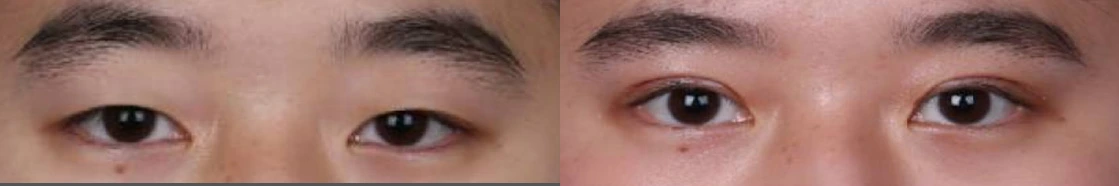 Incisional double-eyelid surgery — before on the left and after on the right at Afternoon Plastic Surgery
