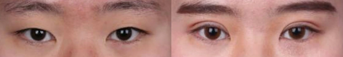 Incisional double-eyelid surgery — before on the left and after on the right at Afternoon Plastic Surgery