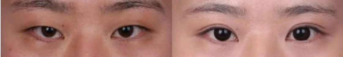 Incisional double-eyelid surgery — before on the left and after on the right at Afternoon Plastic Surgery