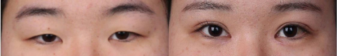 Incisional double-eyelid surgery — before on the left and after on the right at Afternoon Plastic Surgery
