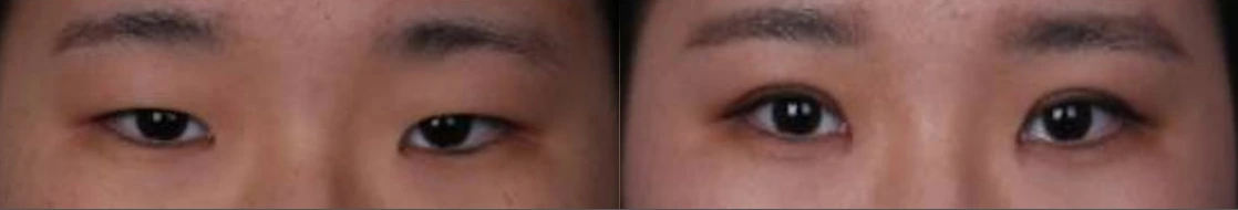 Incisional double-eyelid surgery — before on the left and after on the right at Afternoon Plastic Surgery