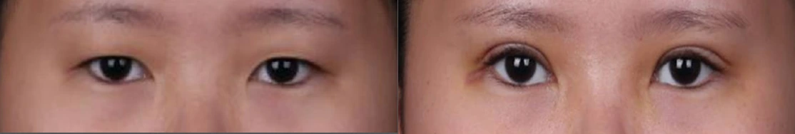 Incisional double-eyelid surgery — before on the left and after on the right at Afternoon Plastic Surgery