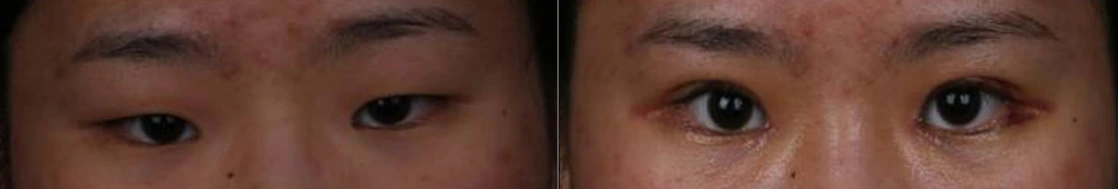 Incisional double-eyelid surgery — before on the left and after on the right at Afternoon Plastic Surgery