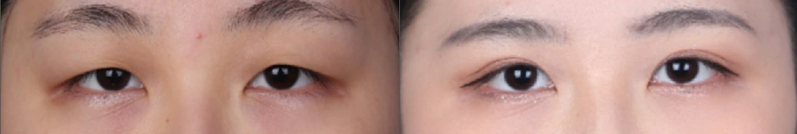 Incisional double-eyelid surgery — before on the left and after on the right at Afternoon Plastic Surgery