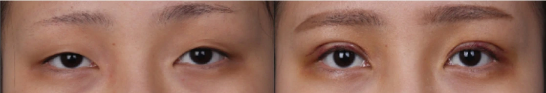 Incisional double-eyelid surgery — before on the left and after on the right at Afternoon Plastic Surgery