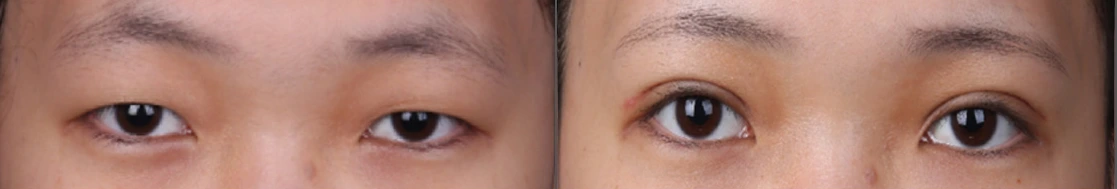 Incisional double-eyelid surgery — before on the left and after on the right at Afternoon Plastic Surgery