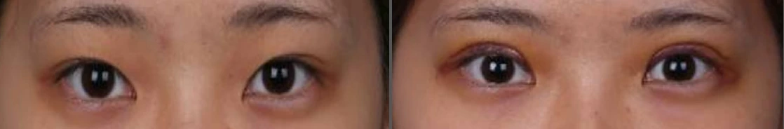 Incisional double-eyelid surgery — before on the left and after on the right at Afternoon Plastic Surgery