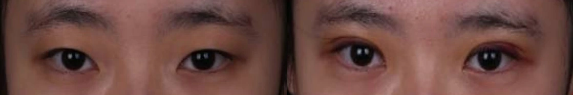 Incisional double-eyelid surgery — before on the left and after on the right at Afternoon Plastic Surgery
