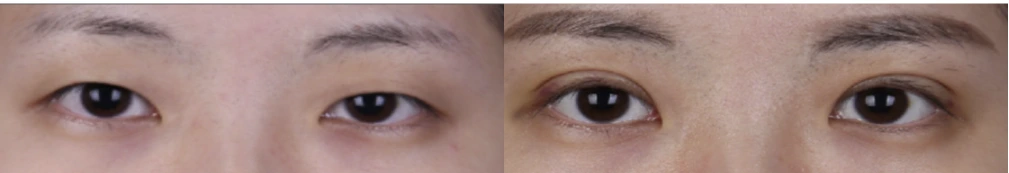 Incisional double-eyelid surgery — before on the left and after on the right at Afternoon Plastic Surgery