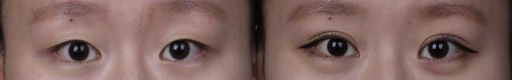 Incisional double-eyelid surgery — before on the left and after on the right at Afternoon Plastic Surgery