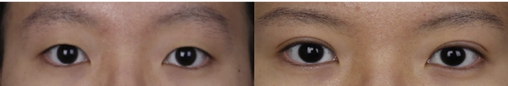 Incisional double-eyelid surgery — before on the left and after on the right at Afternoon Plastic Surgery