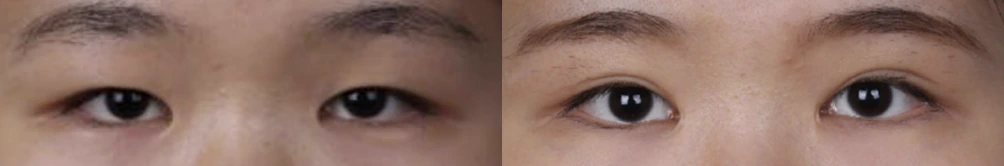 Incisional double-eyelid surgery — before on the left and after on the right at Afternoon Plastic Surgery