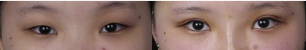 Incisional double-eyelid surgery — before on the left and after on the right at Afternoon Plastic Surgery