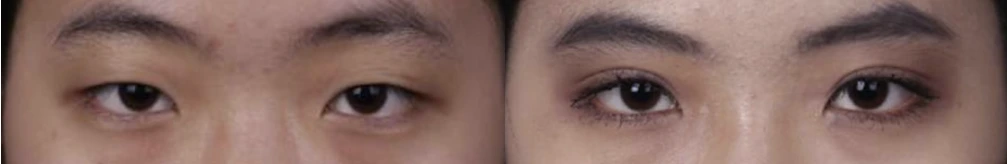 Incisional double-eyelid surgery — before on the left and after on the right at Afternoon Plastic Surgery