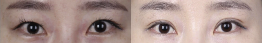 Incisional double-eyelid surgery — before on the left and after on the right at Afternoon Plastic Surgery