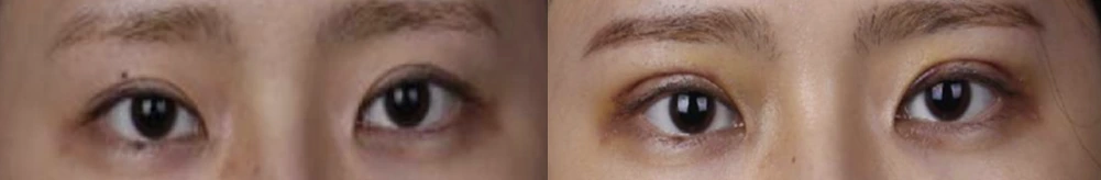 Incisional double-eyelid surgery — before on the left and after on the right at Afternoon Plastic Surgery