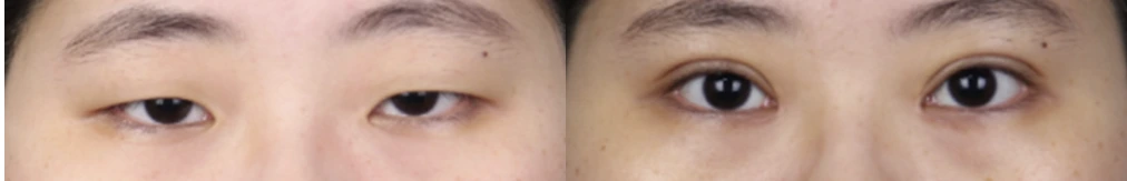 Incisional double-eyelid surgery — before on the left and after on the right at Afternoon Plastic Surgery