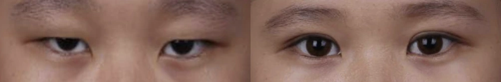 Incisional double-eyelid surgery — before on the left and after on the right at Afternoon Plastic Surgery