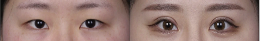 Incisional double-eyelid surgery — before on the left and after on the right at Afternoon Plastic Surgery