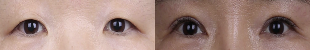 Incisional double-eyelid surgery with inner eye-corner surgery — before on the left and after on the right at Afternoon Plastic Surgery